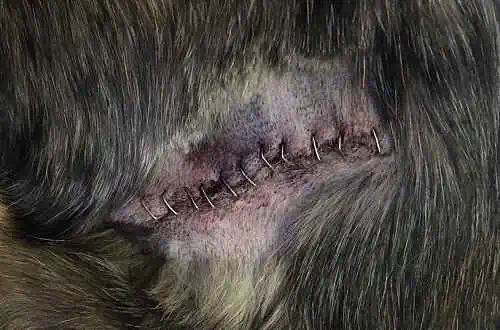 Die Haut wird nach einem entfernten Hot Spot mit Klammern zusammengehalten.